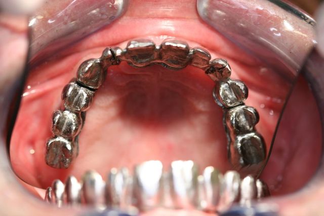Protesis dental 1