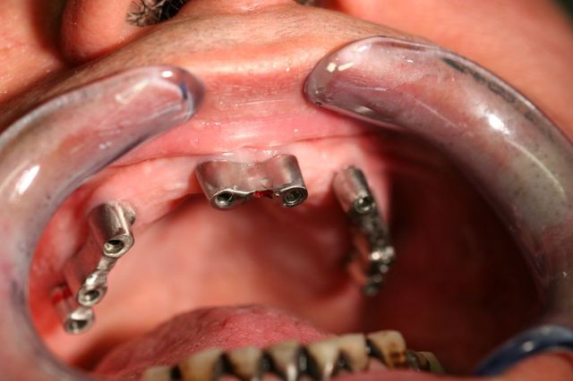 Protesis dental 1